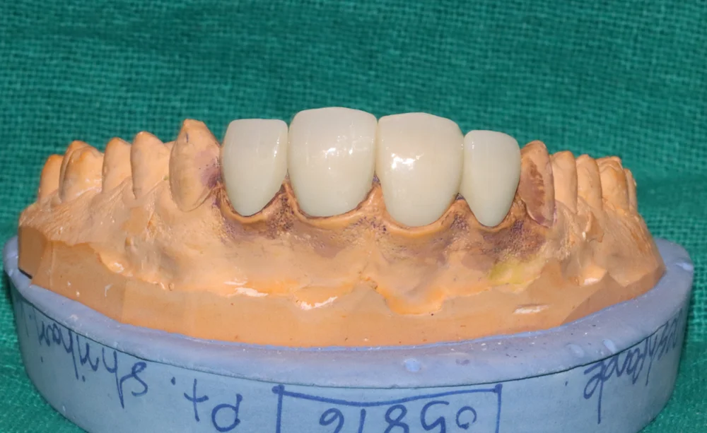4 Unit Laminate Veneers - Image 3