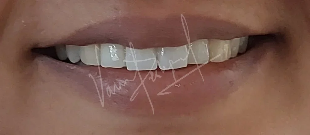 Anterior 2 unit All Ceramic Prosthesis - Image 2