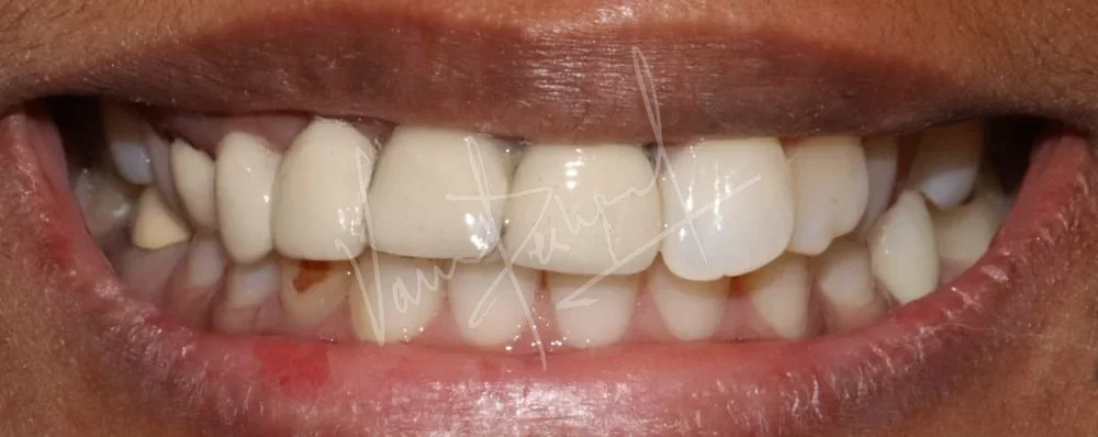 Anterior Zirconia Bridge - Image 1