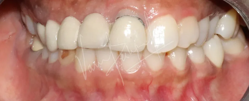 Anterior Zirconia Bridge - Image 2