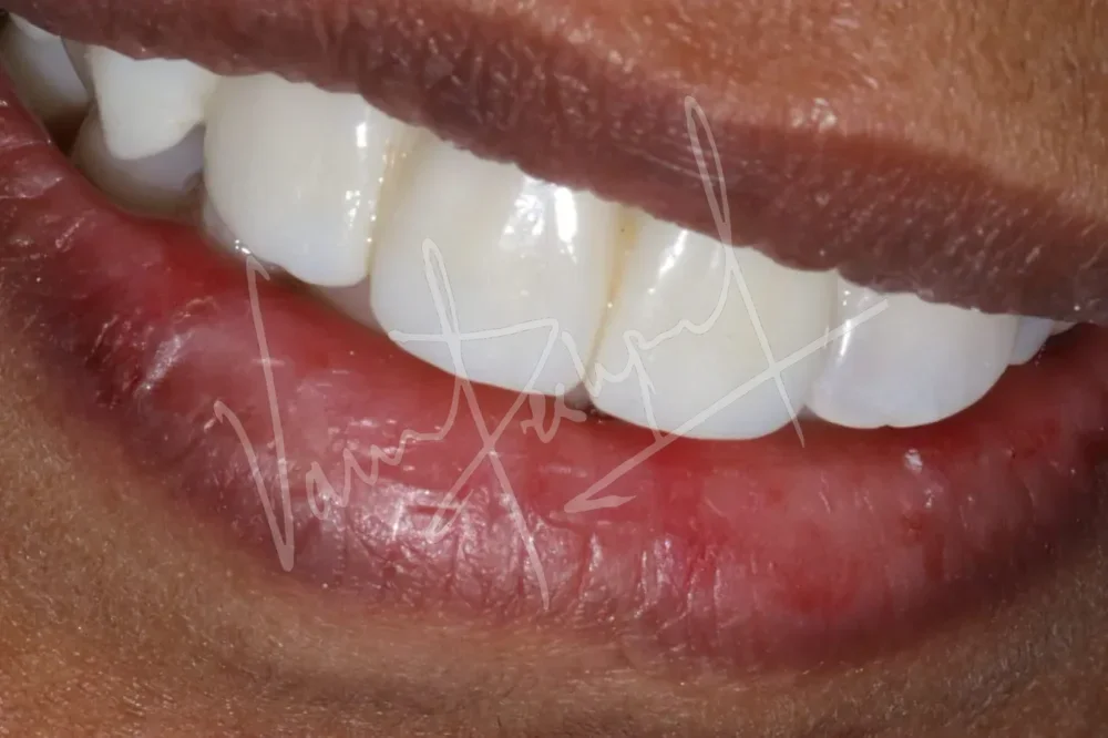 Anterior Zirconia Bridge - Image 5