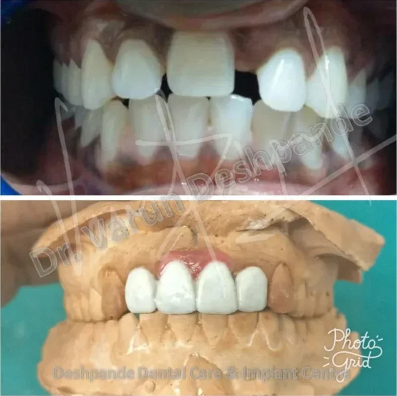 Dental Crowns & Bridges