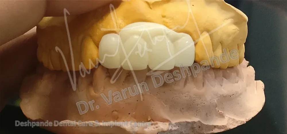 Anterior Zirconia Prosthesis - Image 3