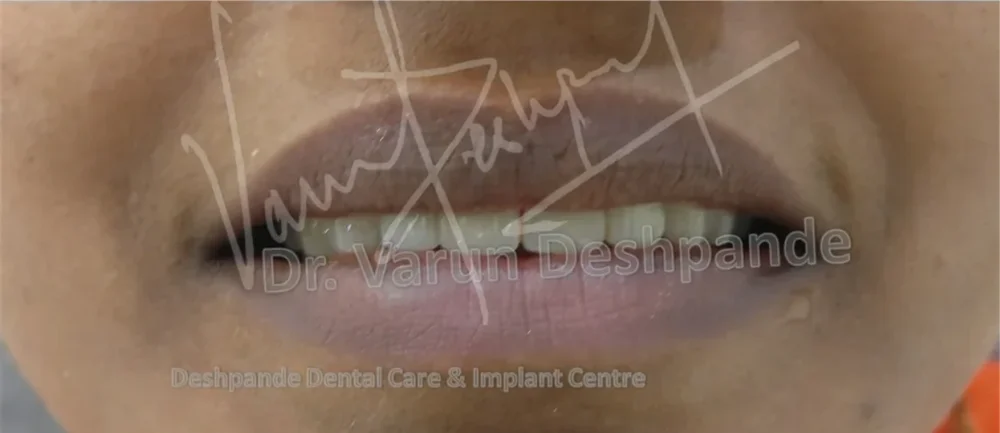 Anterior Zirconia Prosthesis - Image 7