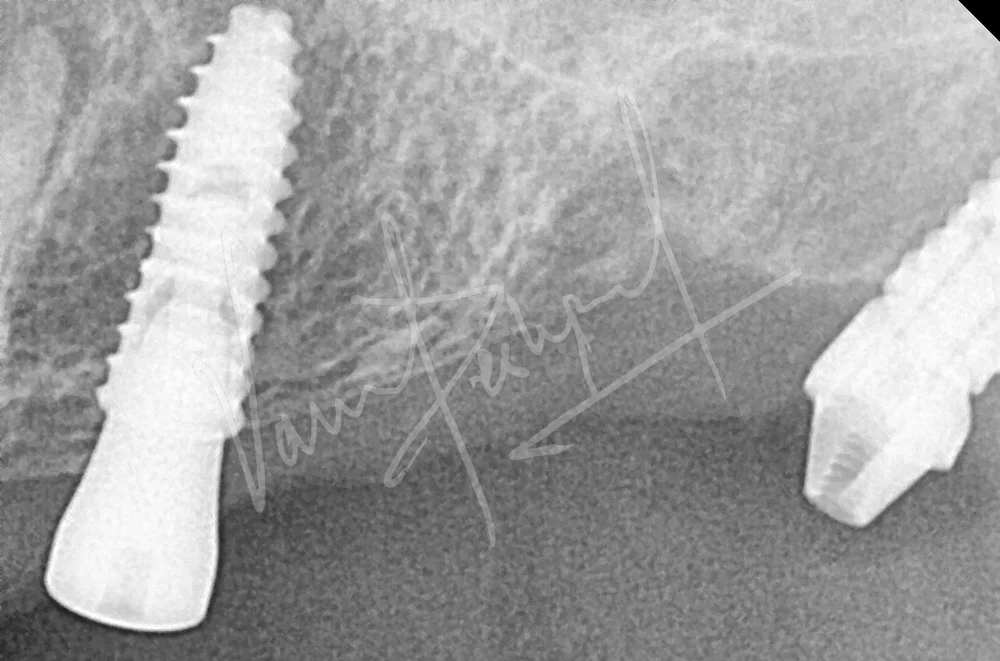 Dental Implants - Image 1