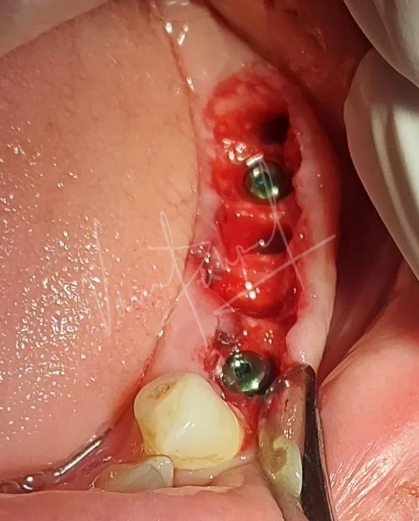 Dental Implants - Image 11