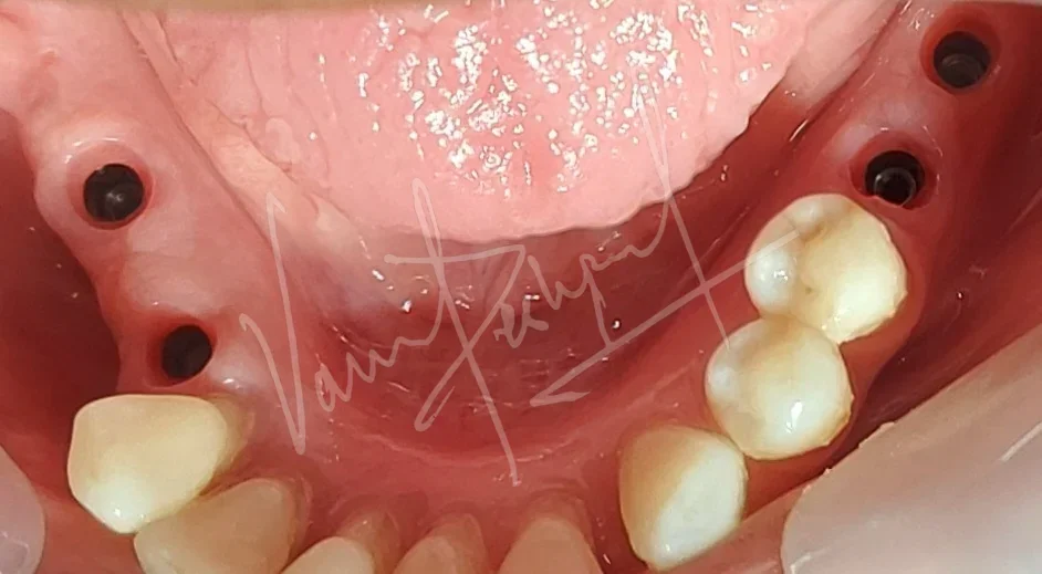 Dental Implants - Image 12