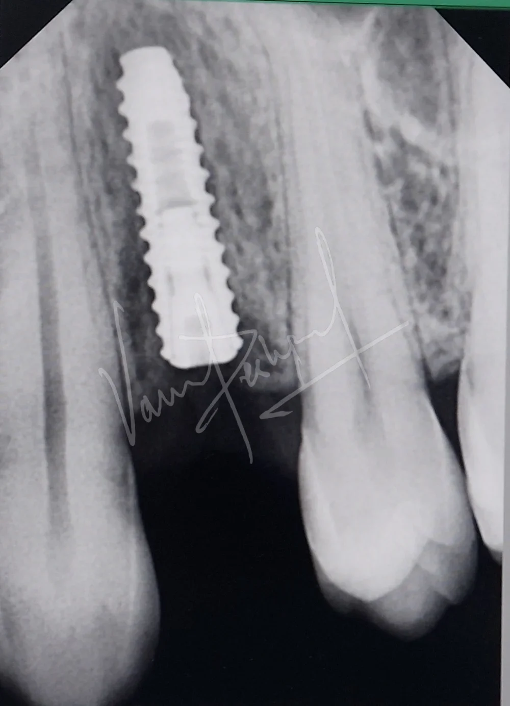 Dental Implants - Image 13