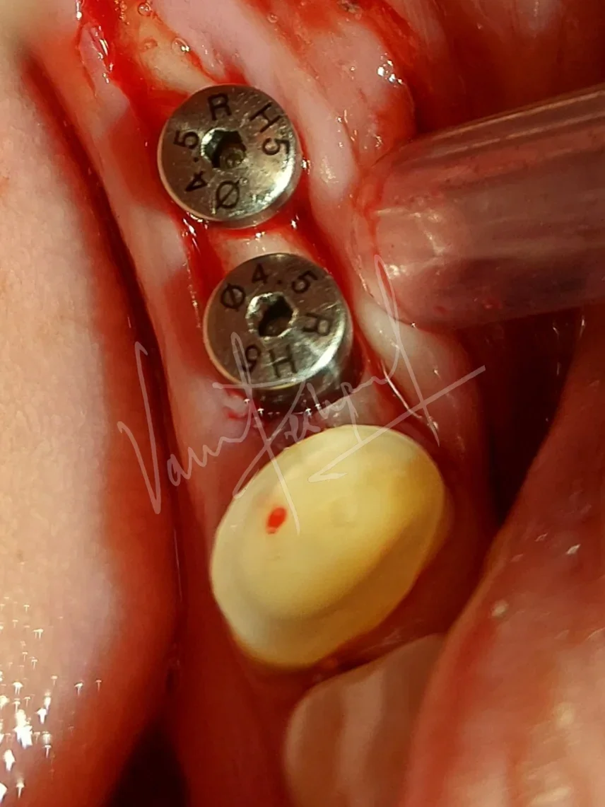 Dental Implants - Image 19