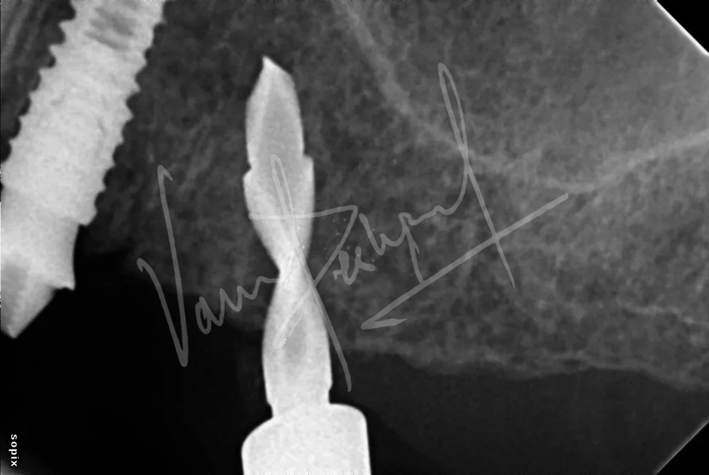 Dental Implants - Image 2