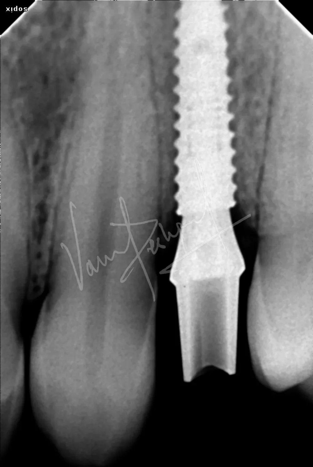 Dental Implants - Image 26