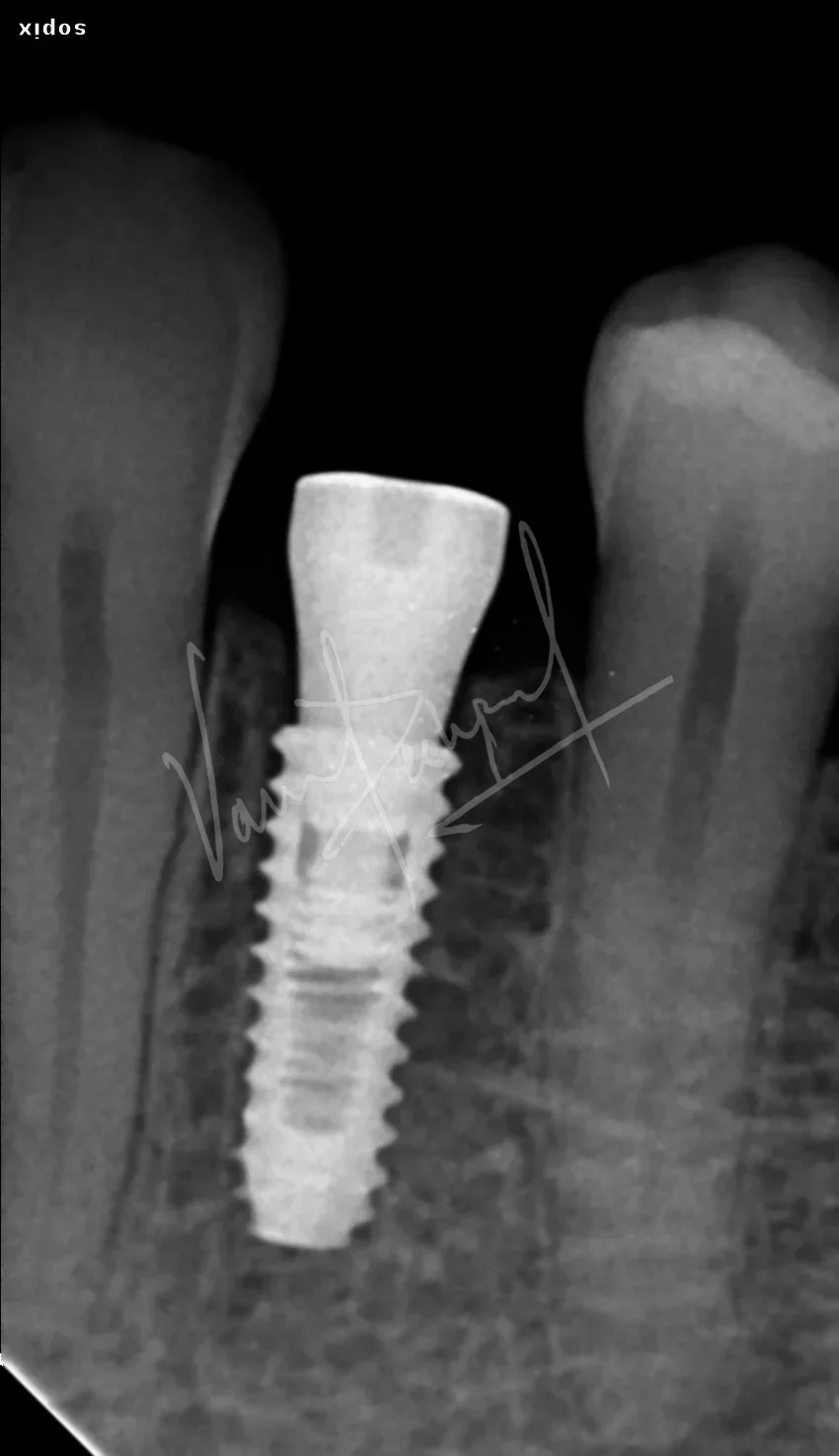 Dental Implants - Image 27