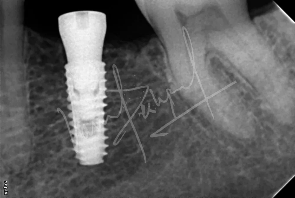 Dental Implants - Image 28