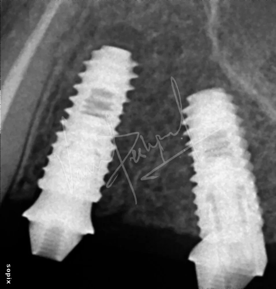 Dental Implants - Image 3