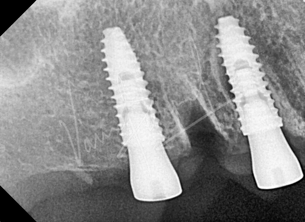 Dental Implants - Image 32