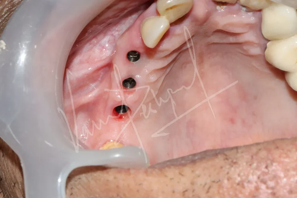 Dental Implants - Image 34