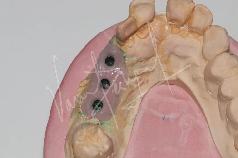 Dental Implants - Image 35