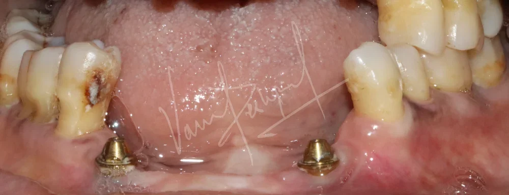 Dental Implants - Image 40