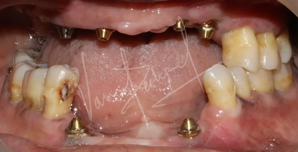 Dental Implants - Image 41
