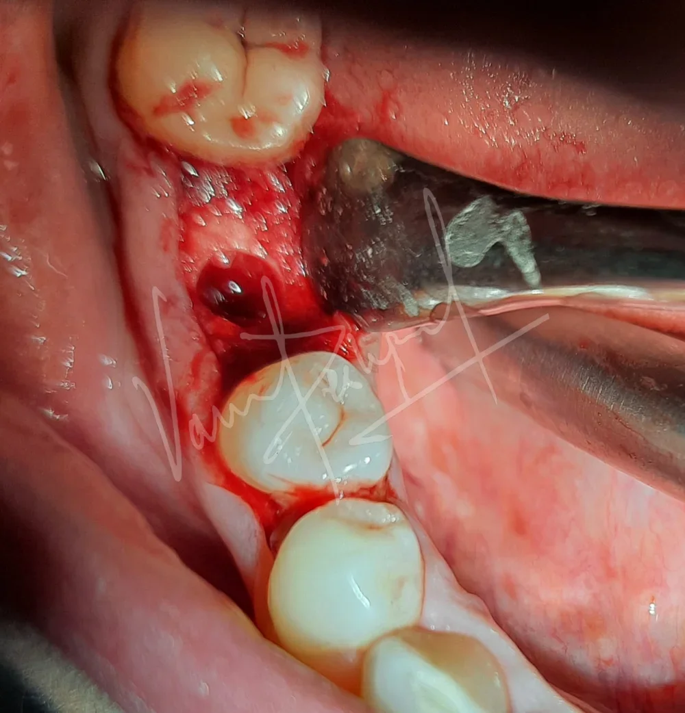 Dental Implants - Image 7