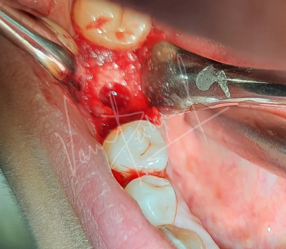 Dental Implants - Image 8