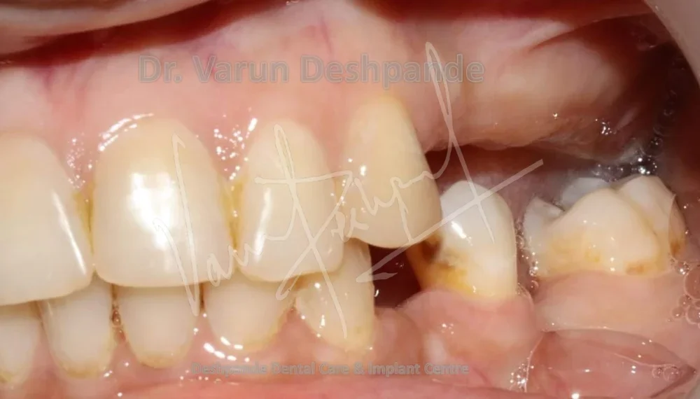 Complete and Partial Dentures