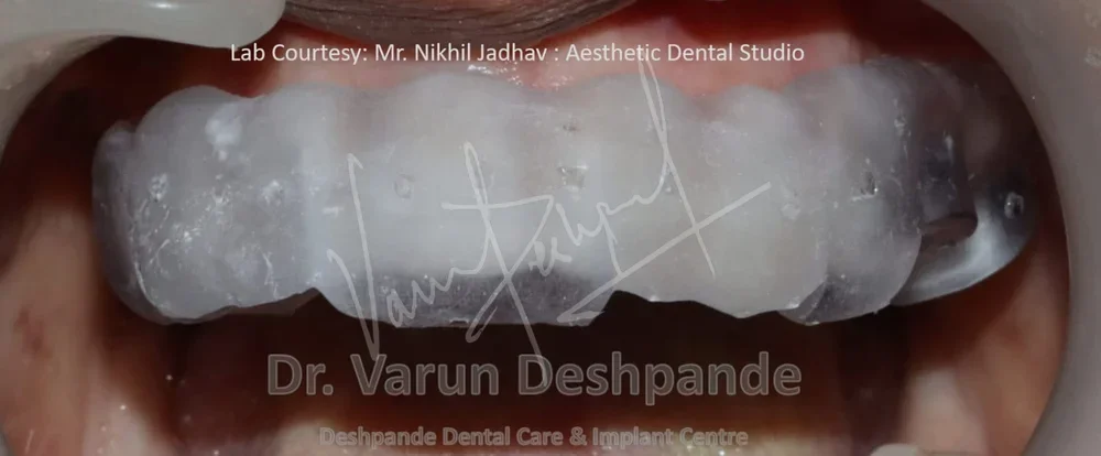 Flapless Guided Implant Surgery - Image 2