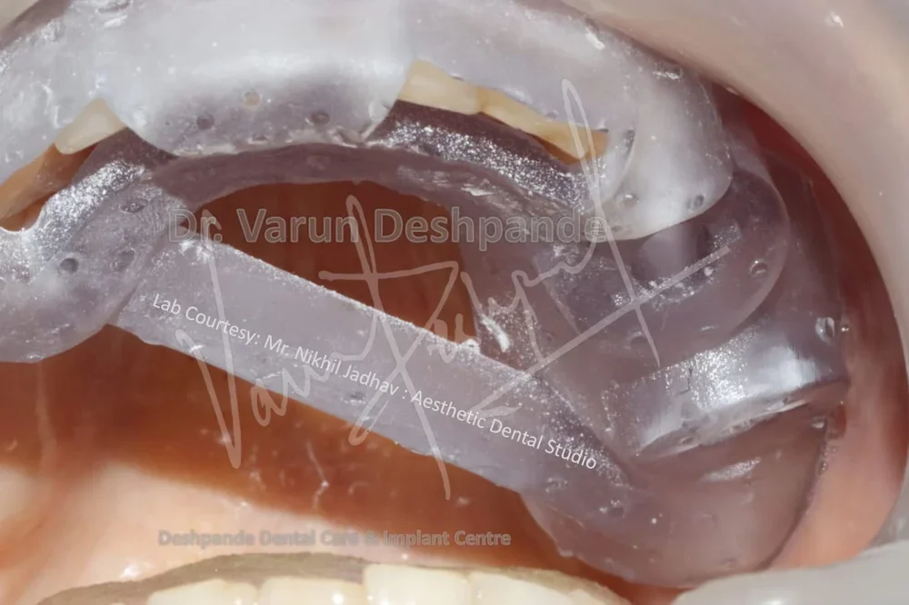 Flapless Guided Implant Surgery - Image 3