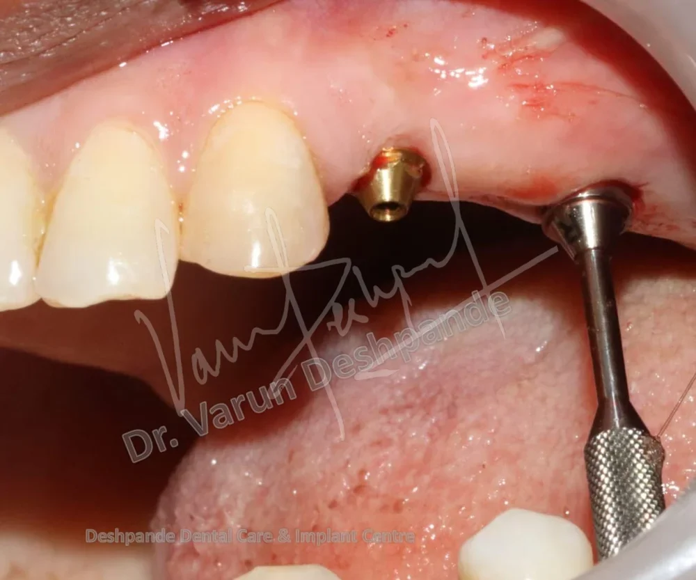 Flapless Guided Implant Surgery - Image 6