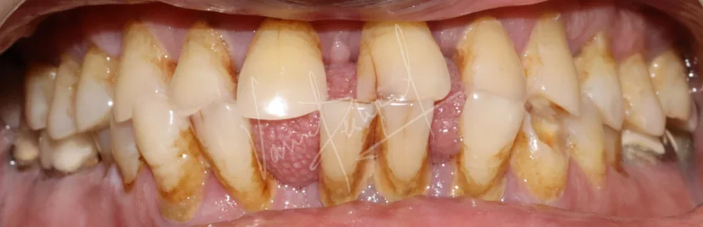 FMR using All Ceramic Prosthesis - Image 2