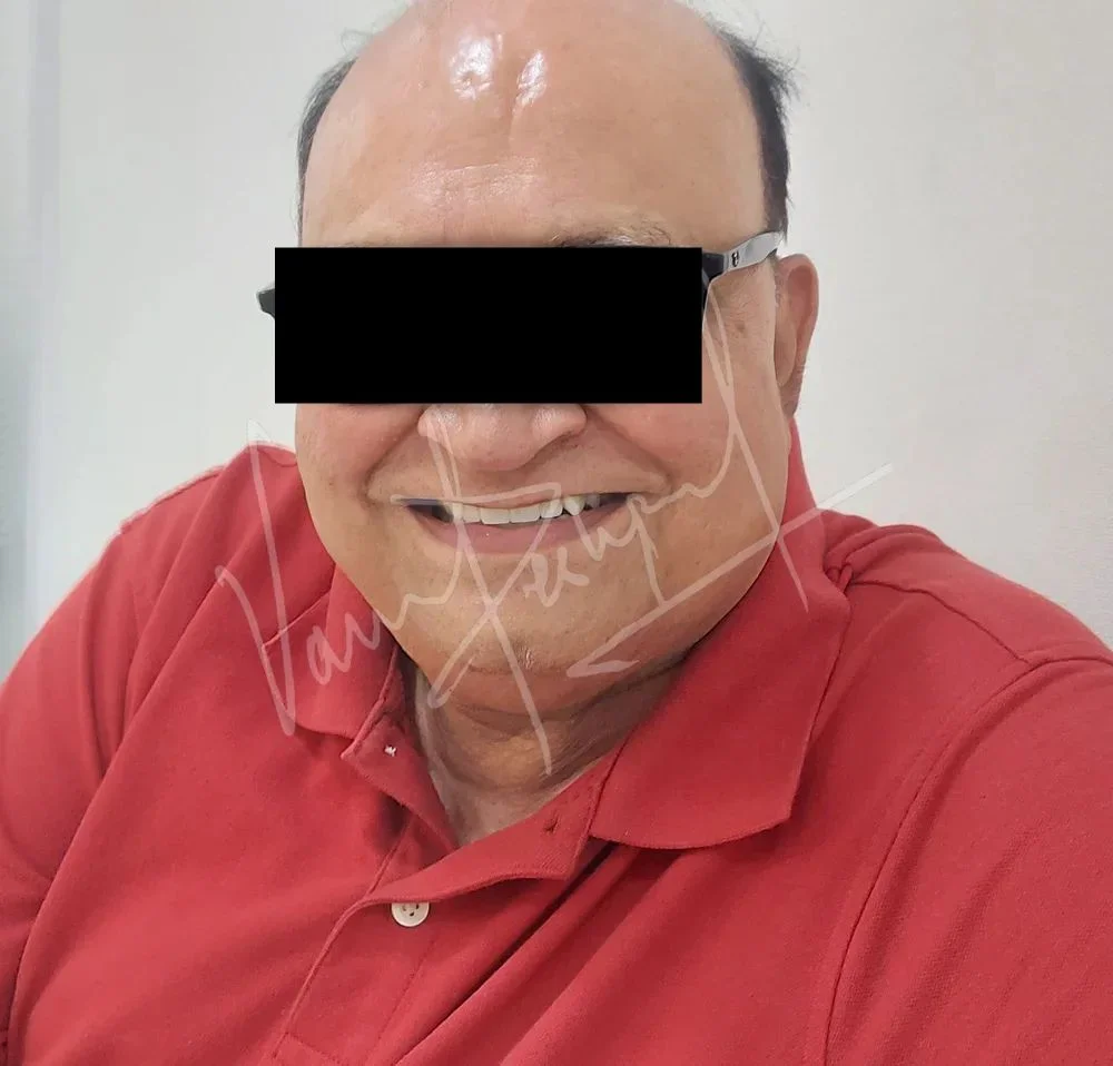 FMR using All Ceramic Prosthesis - Image 3