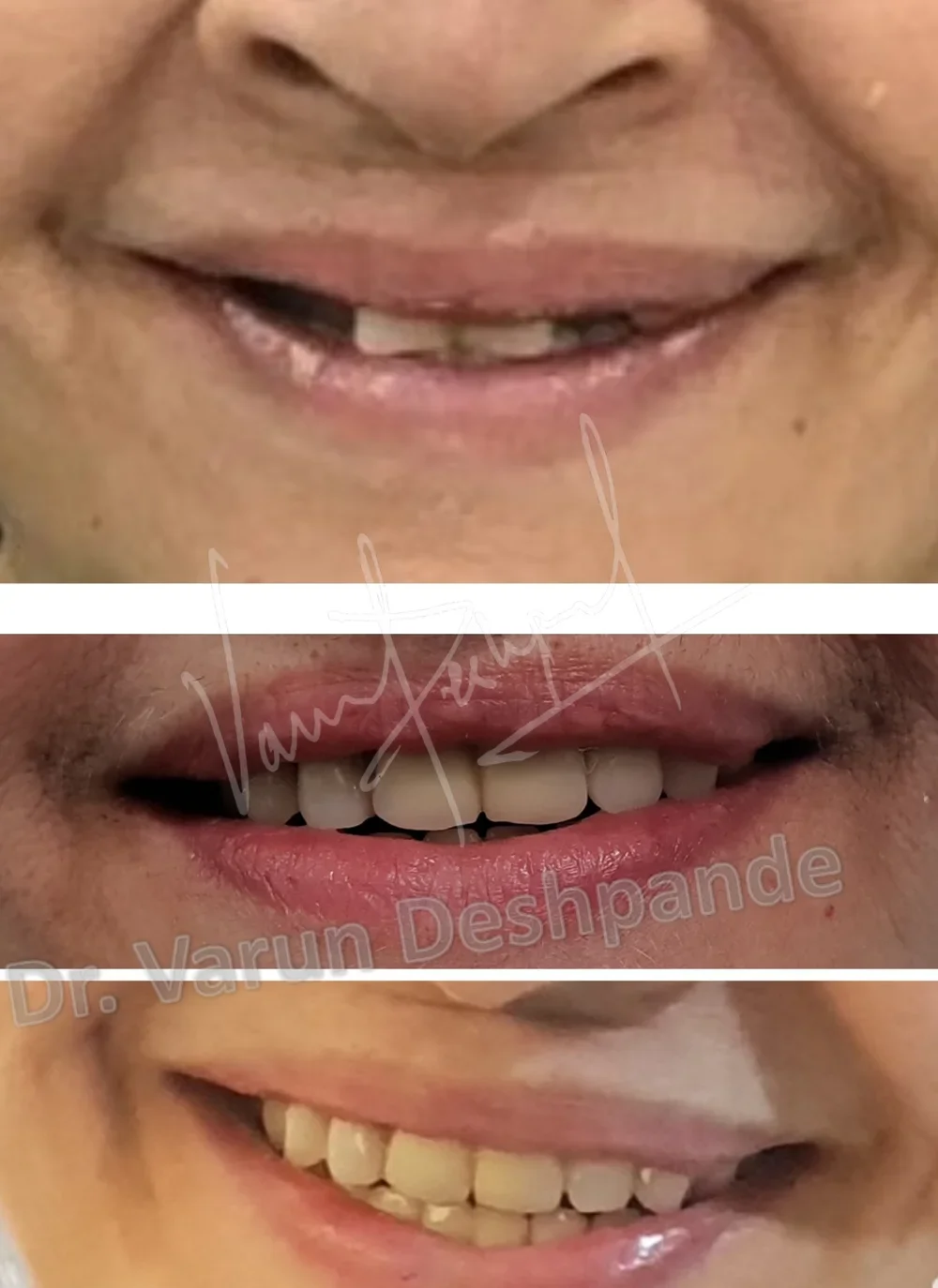 FMR using Crown and Bridge and Precision Attachment - Image 1