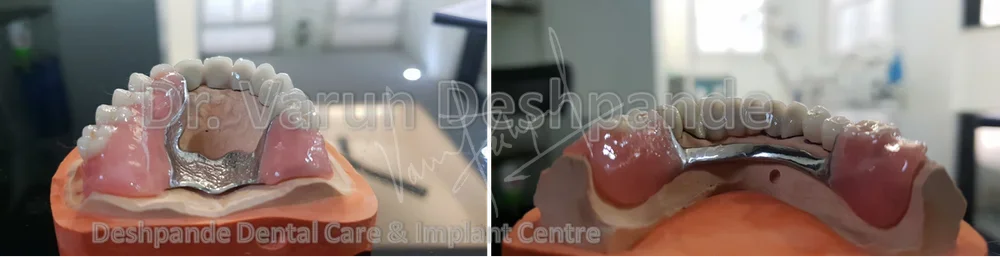 FMR using Crown and Bridge and Precision Attachment - Image 2