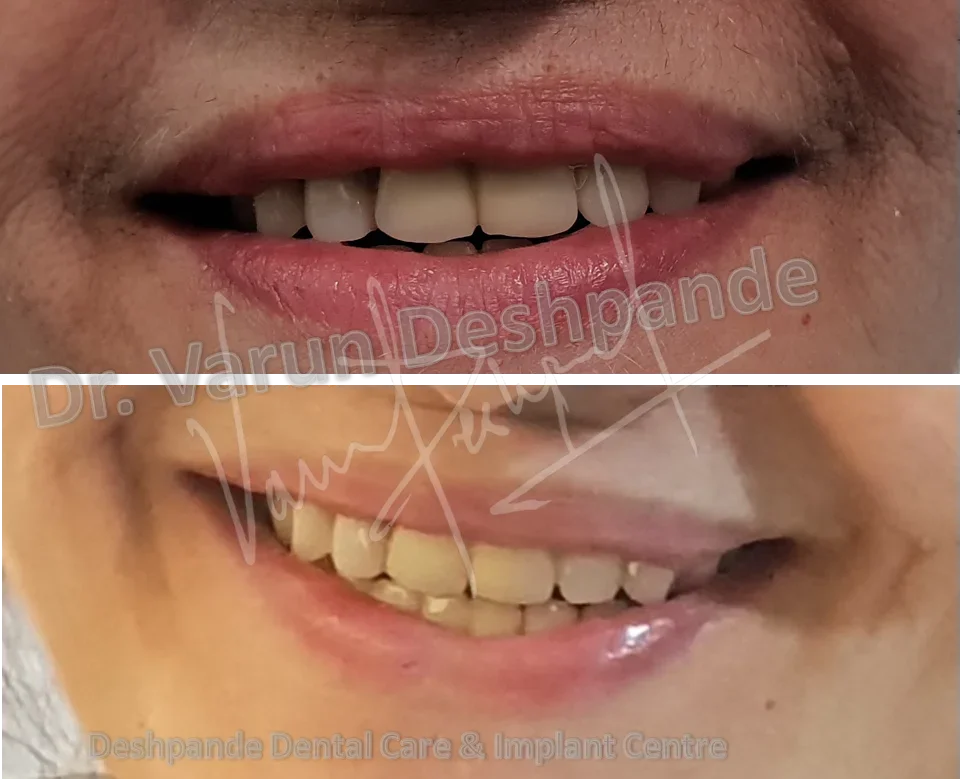 FMR using Crown and Bridge and Precision Attachment - Image 3