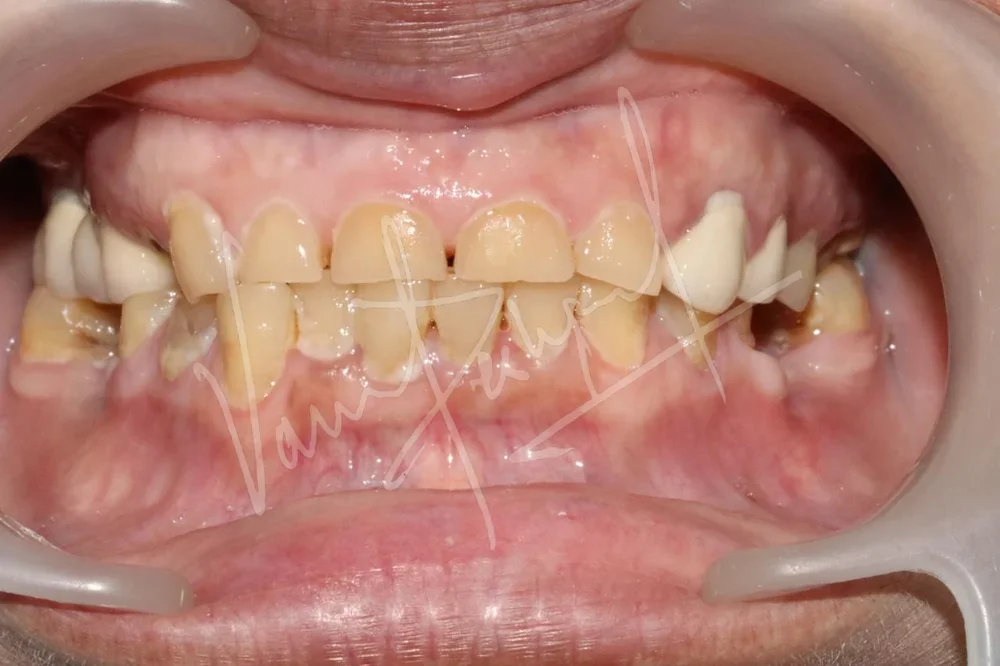 FMR using Metal Ceramic Prosthesis - Image 1
