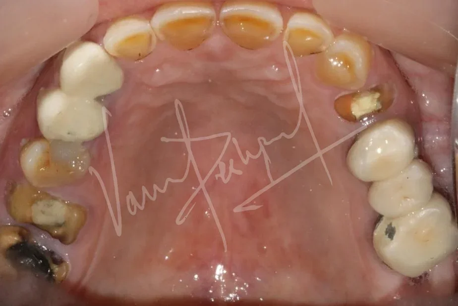 FMR using Metal Ceramic Prosthesis - Image 2