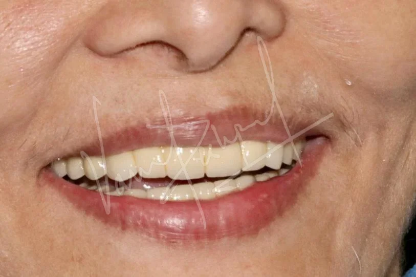 FMR using Metal Ceramic Prosthesis - Image 5