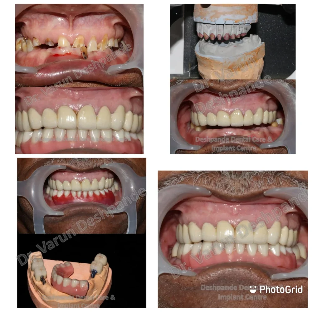 FMR using Precision Attachment with Crown and Bridge and Dental Implants - Image 1