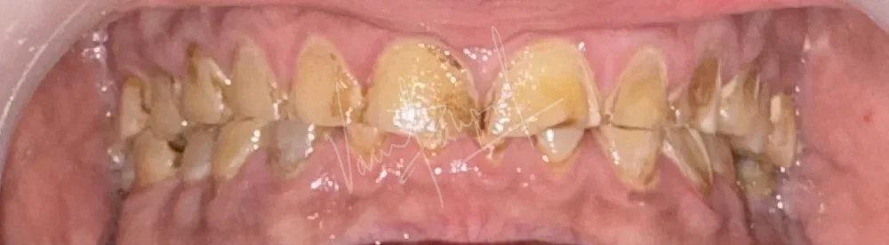 FMR using Zirconia Prosthesis - Image 1