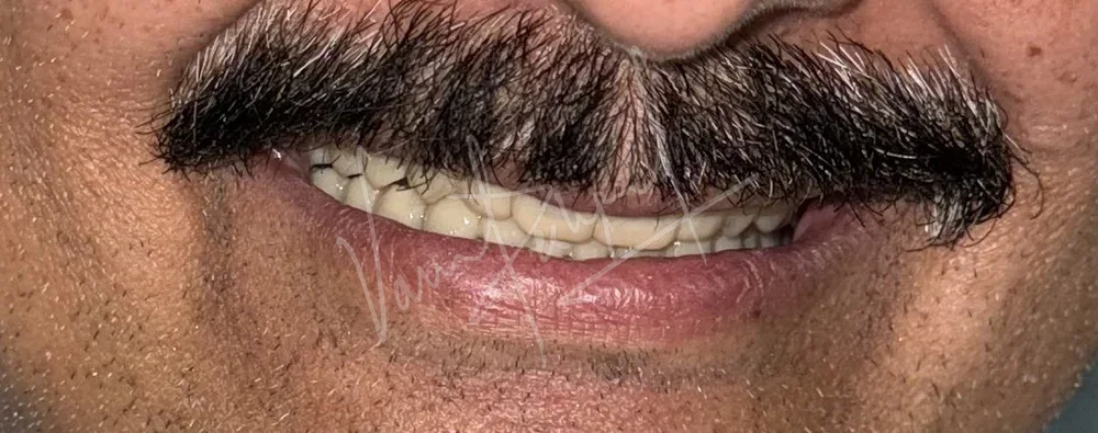 FMR using Zirconia Prosthesis - Image 10