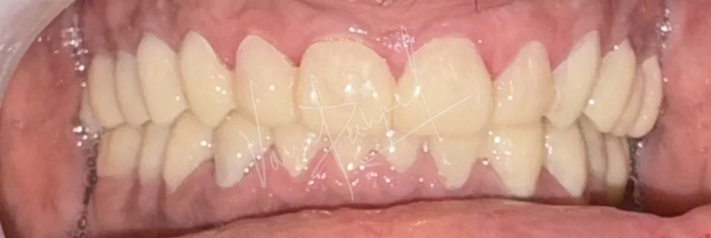 FMR using Zirconia Prosthesis - Image 12