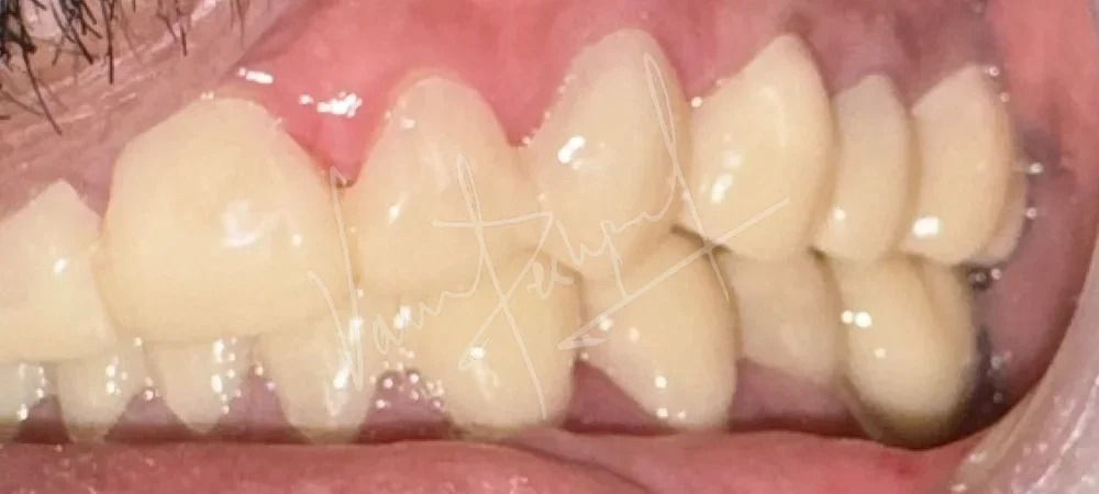 FMR using Zirconia Prosthesis - Image 14