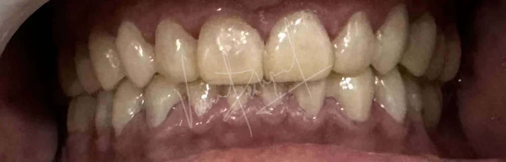 FMR using Zirconia Prosthesis - Image 15