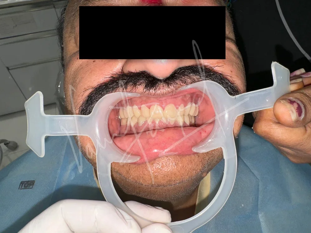 FMR using Zirconia Prosthesis - Image 16