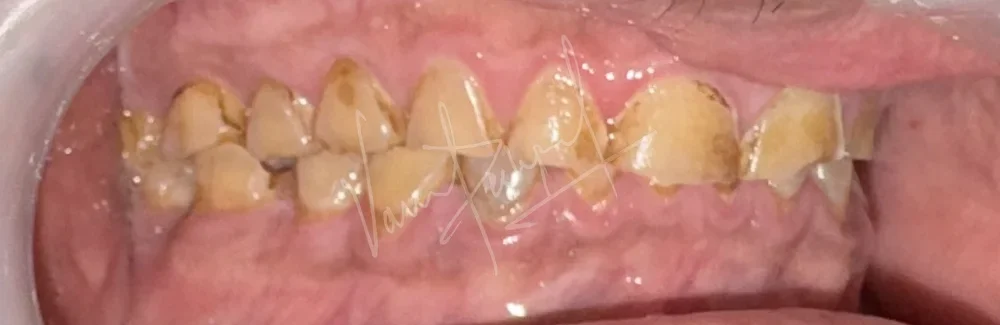 FMR using Zirconia Prosthesis - Image 2