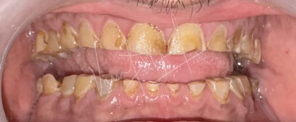 Clinical comparison of a patient with severe tooth wear before and after Full Mouth Rehabilitation.