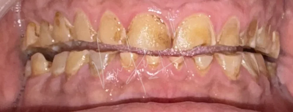 FMR using Zirconia Prosthesis - Image 5