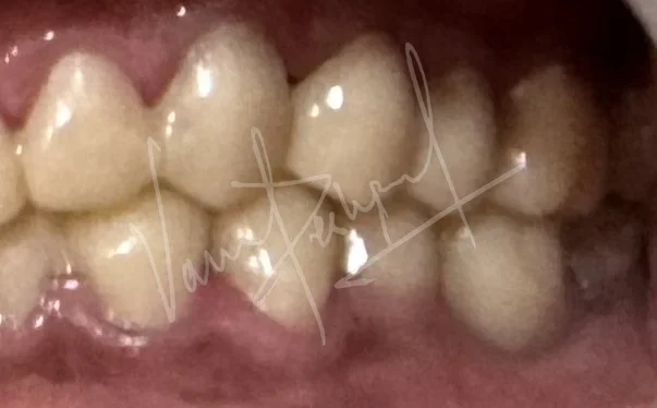 FMR using Zirconia Prosthesis - Image 8
