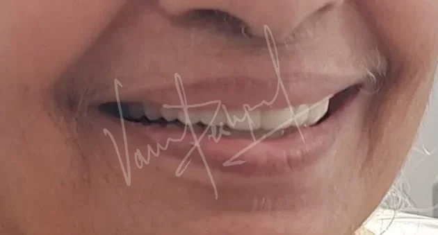 FMR with Metal Ceramic Prosthesis - Image 3