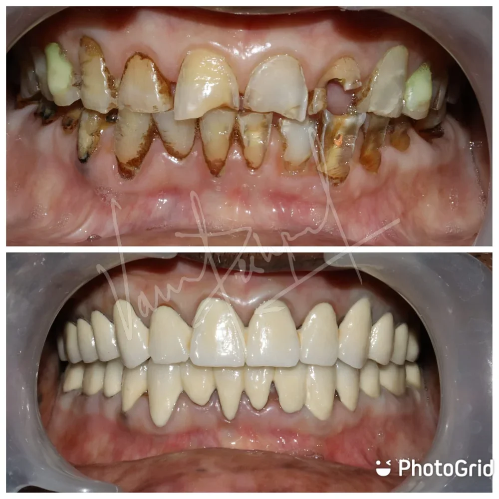 FMR with Porcelain-Fused-to-Metal Prosthesis - Image 1